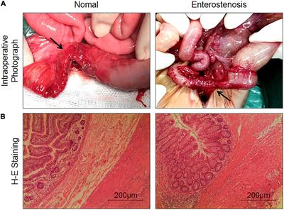 Expression and Possible Role of Silent Mating Type Information Regulation 2 Homolog 1 in Post-necrotizing Enterocolitis Stricture in vivo and in vitro